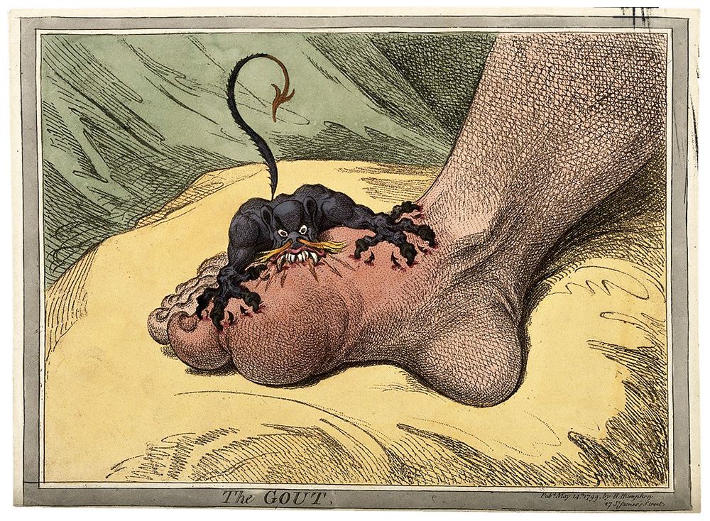Humorous engraving of a gouty foot